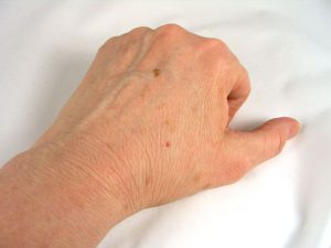 لکهای روی دست بعد از افزایش سن 