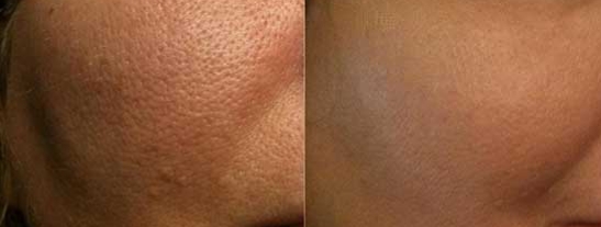 درمان جوش صورت با صابون و کوچکتر شدن منافذ صورت